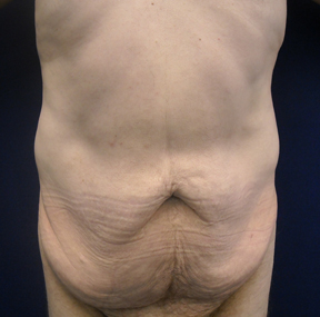 Chicago Abdominoplasty Tummy Tuck 